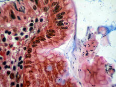 Magenschleimhaut entzündlich infiltriert,  an der Oberfläche Bakterien (Helicobacter pylori).