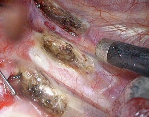 Abb 5: endgültiges OP-Ergebnis: Nervenästchen in den Zwischenrippenräumen sind mittels Hochfrequenzstrom durchtrennt