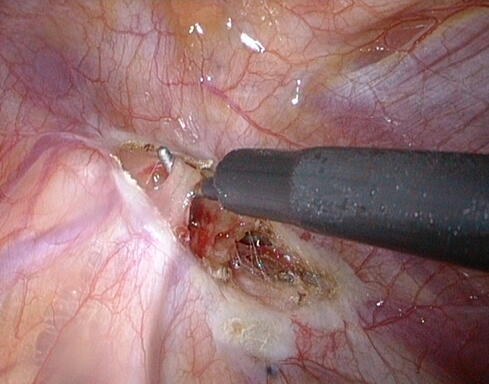 Abb 2: N. sympathicus isoliert und mit Haken angehoben (Außendurchmesser des Instrumentes: 5 mm). Clipapplikator mit Titanclip