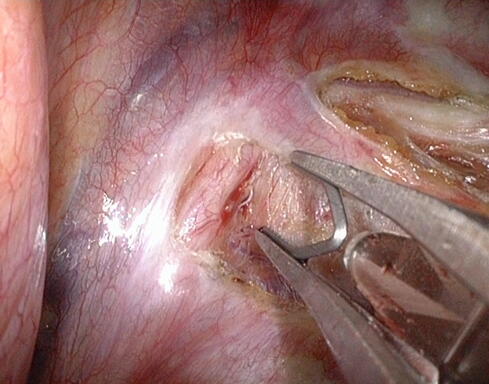 Abb 3: Clipapplikator mit Titanclip, Clips zur Unterbrechung des Nerven