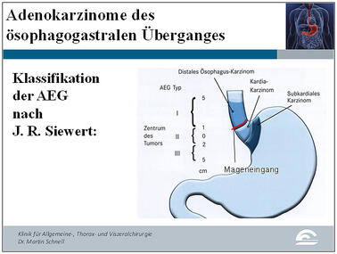 Abb.9: Darstellung der AEG-Typen I-III in der Klassifikation nach Siewert. Die rote Linie markiert den Mageneingang, an welchem sich die Höhenlokalisation des Tumors und damit auch seine Klassifikation ausrichtet