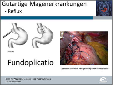 Abb.7: Darstellung einer laparoskopischen Fundoplicatio