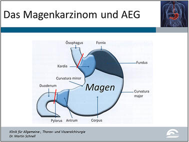 Abb.8: Darstellung der Speiseröhre (= Ösophagus, oberhalb der oberen roten Linie), des Magens mit den unterschiedlichen Regionen, des Zwölffingerdarms (hinter der unteren roten Linie)