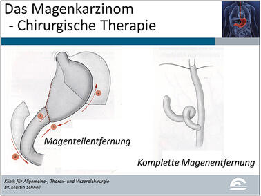 Abb.10: Darstellung einer Magenteilentfernung („subtotale Magenresektion“) mit Verbindung zwischen verbliebenem Magenrest und Dünndarm sowie Darstellung einer kompletten Magenentfernung („Gastrektomie“) mit Wiederherstellung der Passage durch Verbindung von Speiseröhre und Dünndarm
