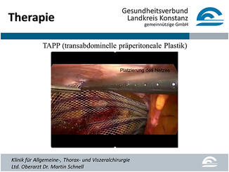 Abb. 6: Endoskopische Reparation eines Leistenbruches mit Netzverstärkung