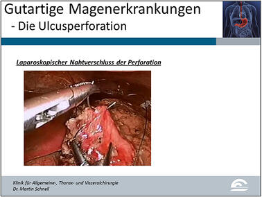 Abb.3: Laparoskopische Ansicht eines Nahtverschlusses bei Magenperforation