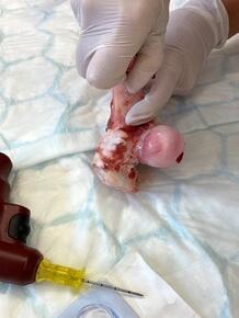 Intraossäre Kanüle mit einer Cook Nadel - der EZIO® - Bohrer wird bevorzugt eingesetzt.