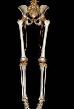 3-D-Rekonstruktion einer CT-Angiographie
