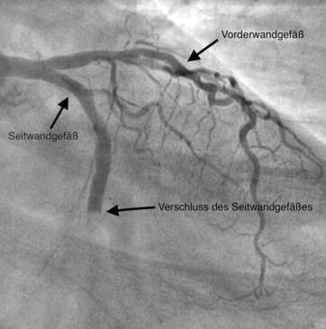 Verschlossenes Seitwandgefäß bei akutem Herzinfarkt