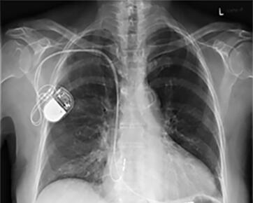 Röntgenbild mit einem Herzschrittmacher