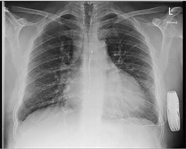 Röntgenbild mit einem subcutanen ICD