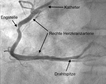Rechte Herzkranzarterie mit Stenose und einliegendem FFR-Draht zur Vermessung